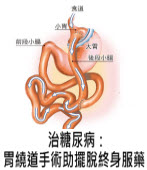  治糖尿病：胃繞道手術助擺脫終身服藥- 台灣e新聞